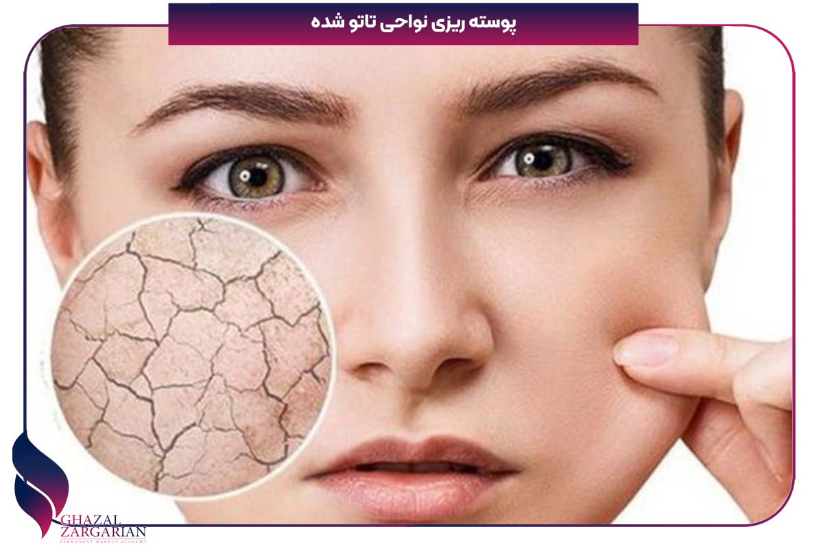 برای پوست پوست شدن صورت چی خوبه