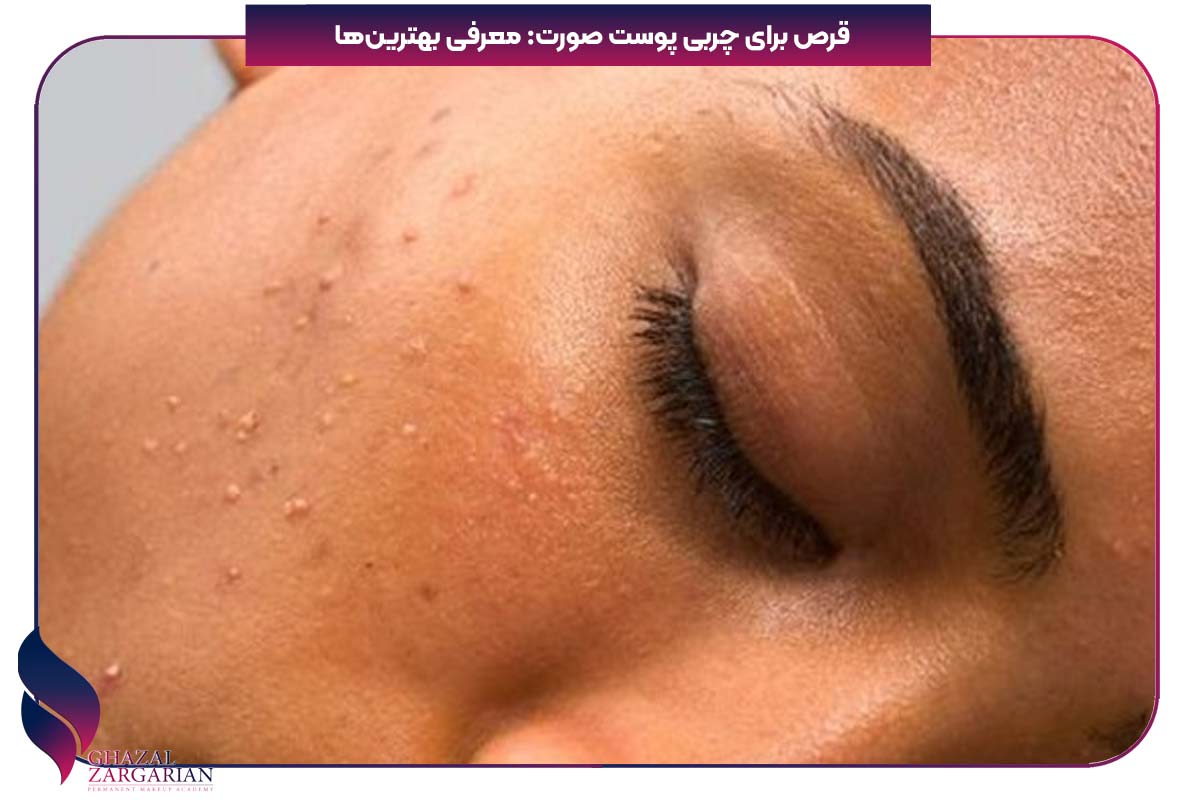 برای کنترل چربی پوست صورت چه کنیم