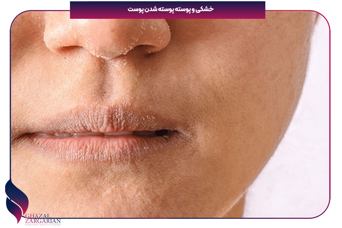 تاثیر استرس بر پوست