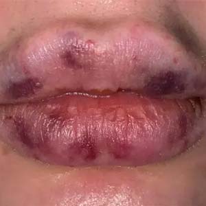 ترشح چرک از ناحیه لب بعد از میکروپیگمنتیشن ترشح چرک از ناحیه لب بعد از میکروپیگمنتیشن
