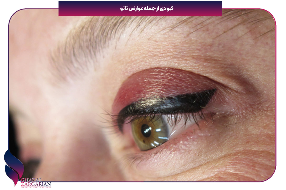 خطرات تتو