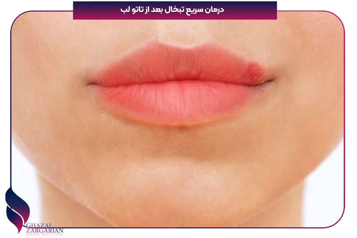 درمان سریع تبخال بعد از تاتو لب