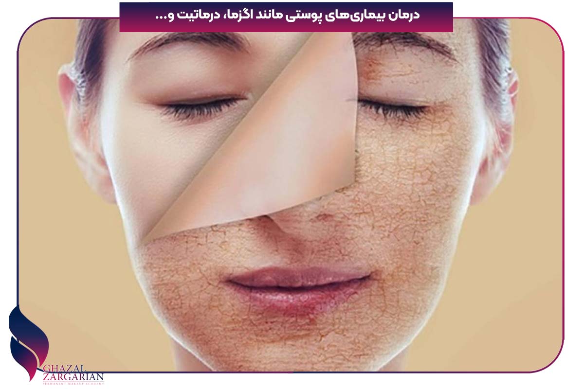 درمان پوست پوست شدن صورت