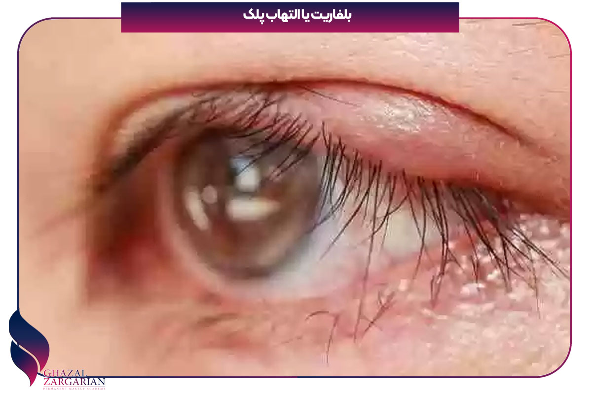 دلایل ریزش مژه