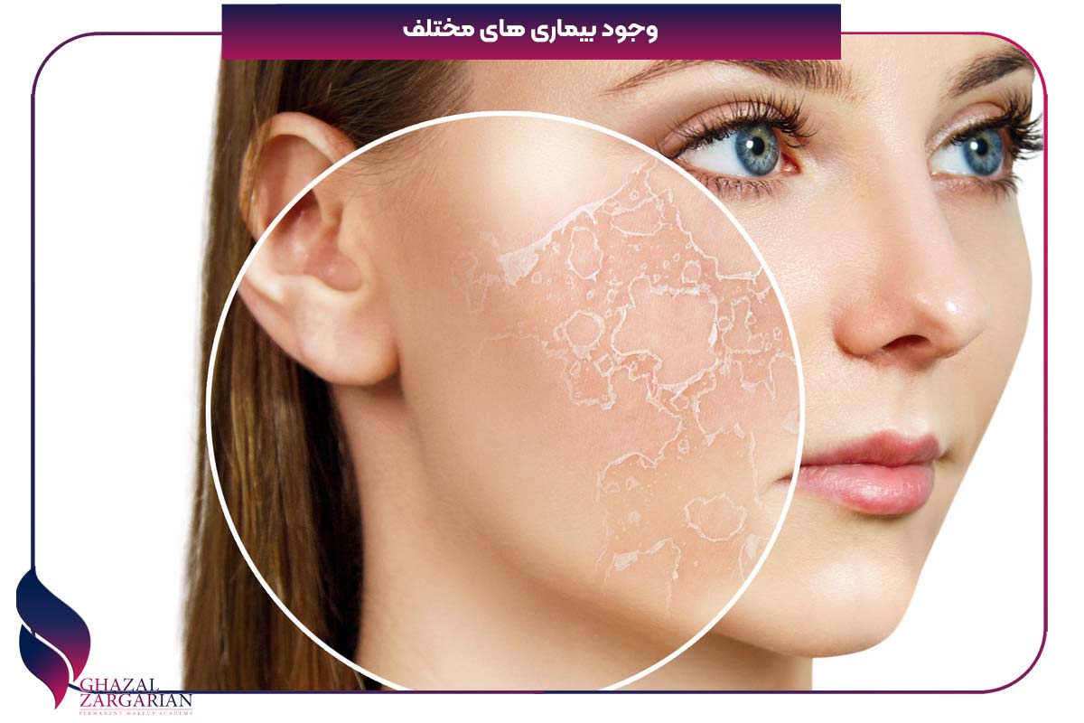 رفع پوسته پوسته شدن صورت