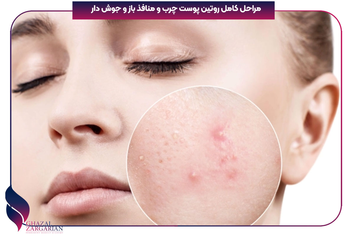 روتین مراقبت از پوست چرب و جوش دار