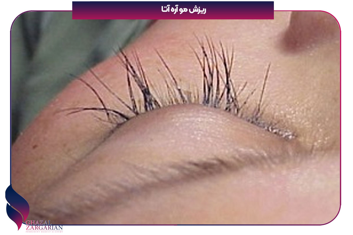 ریختن مژه