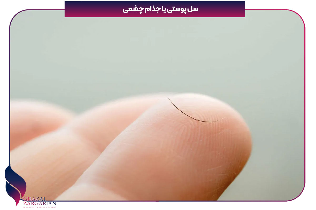 سل پوستی یا جذام چشمی از دلایل ریزش مژه ها