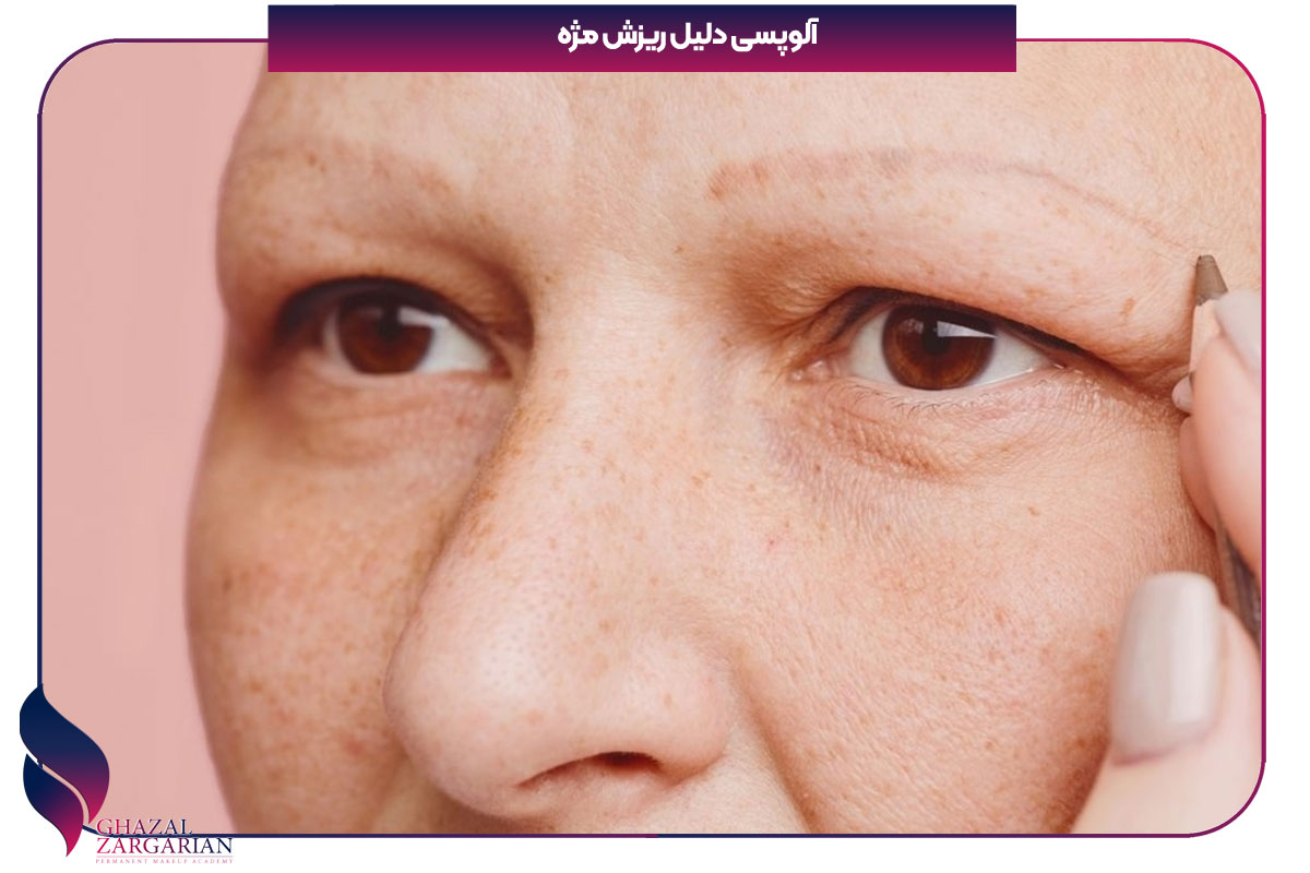علت ریزش مژه چیست