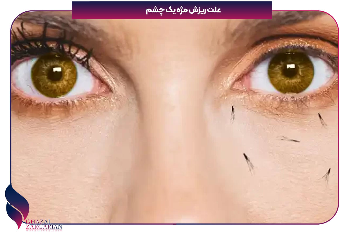 علت ریزش مژه یک چشم
