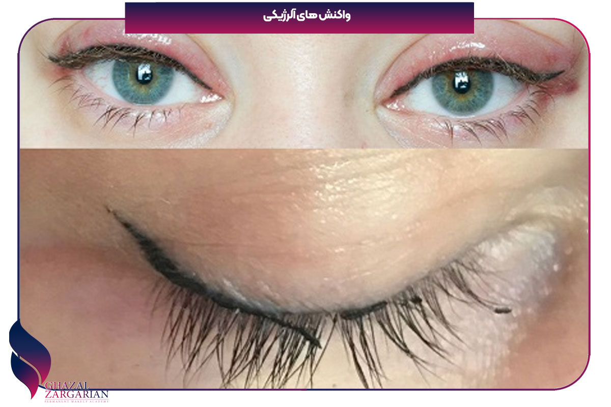 عوارض تاتو