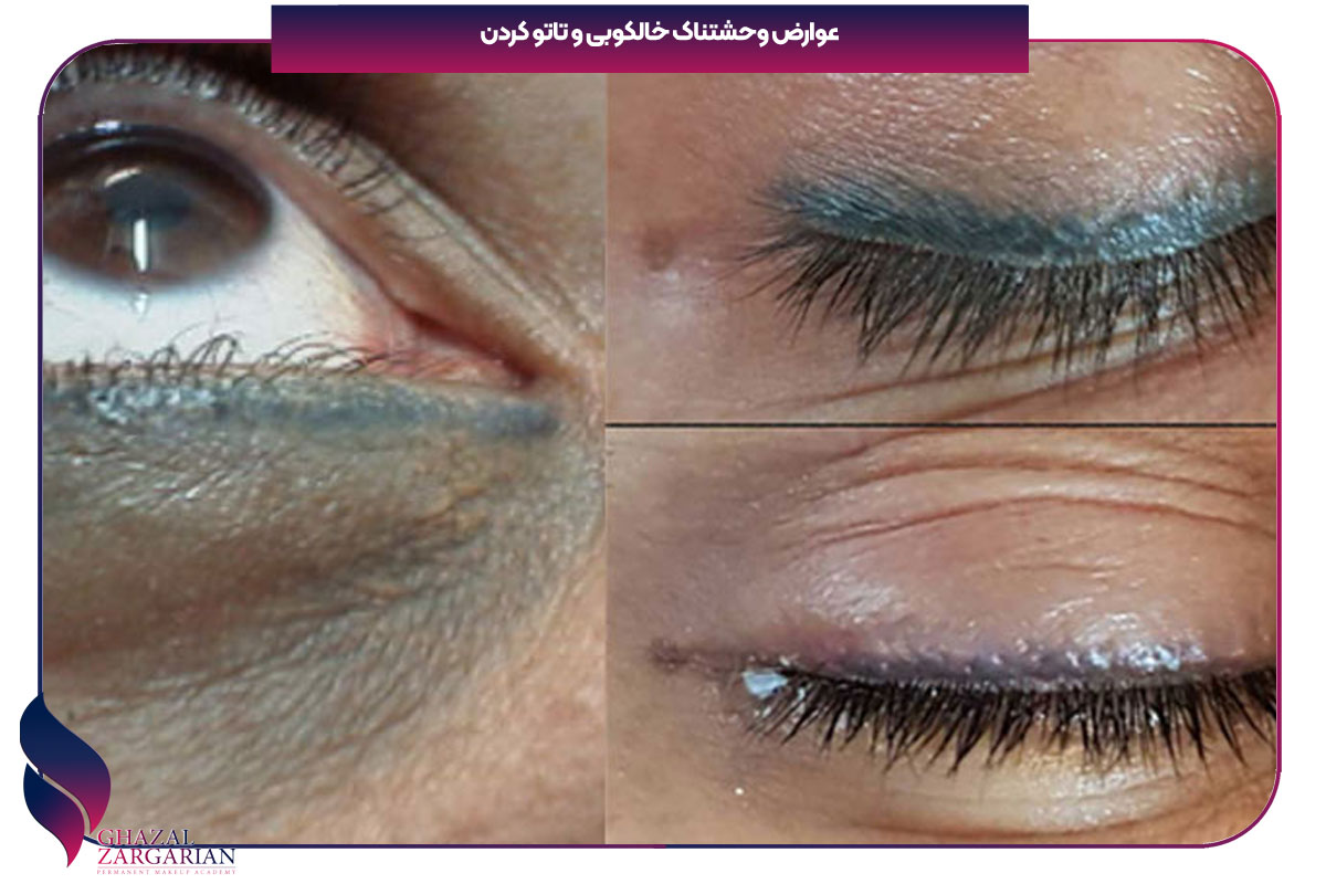 عوارض تتو