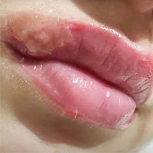 عکس عفونت لب بعد از تاتو لب عکس عفونت لب بعد از تاتو لب