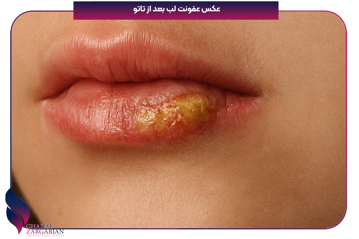 عکس عفونت لب بعد از تاتو