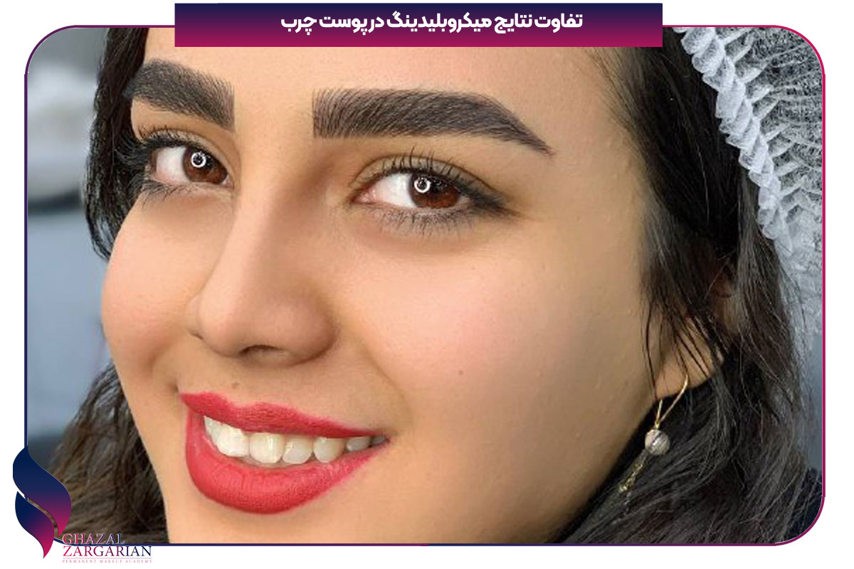 قرص کاهش چربی پوست صورت
