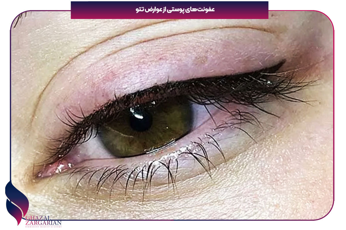 مضرات تتو