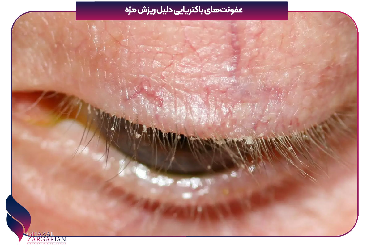 مژه هام ریخته چیکار کنم
