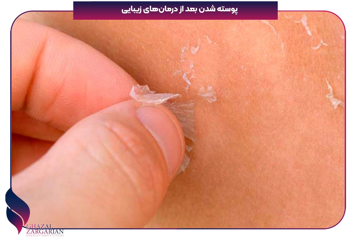 پوسته شدن صورت