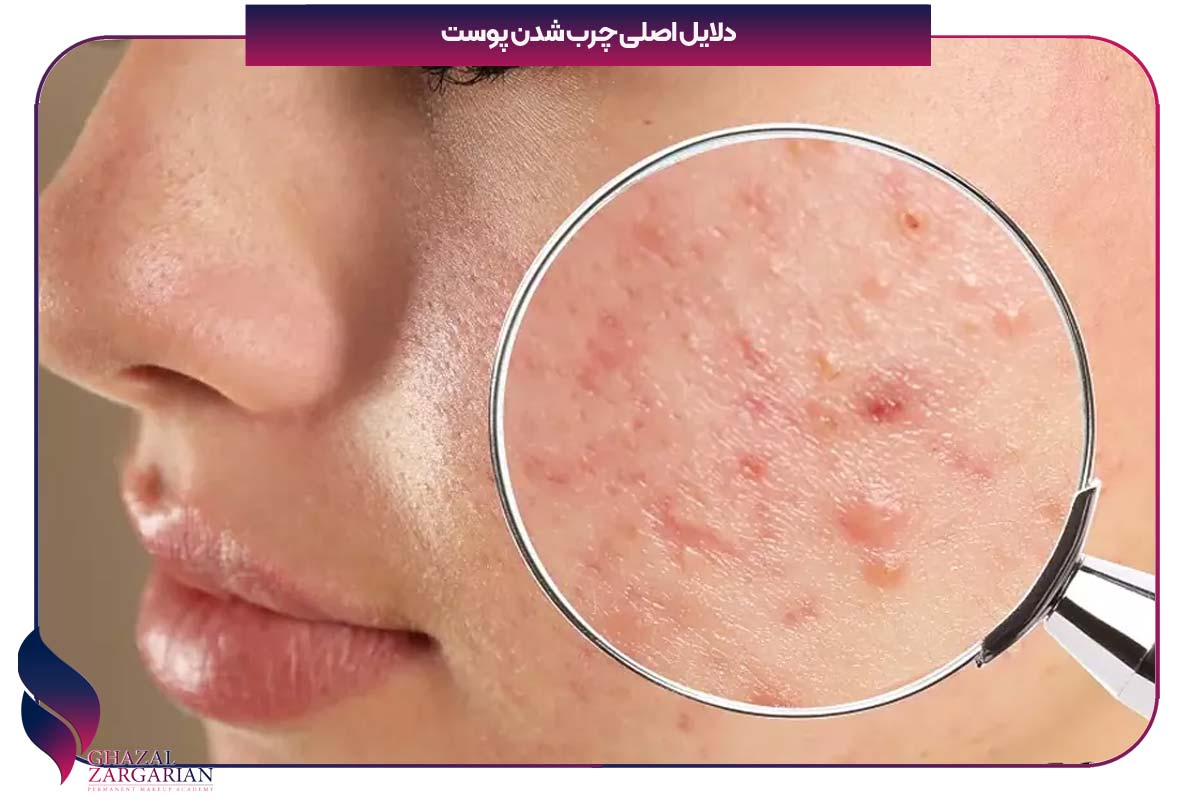چگونه چربی پوست را از بین ببریم