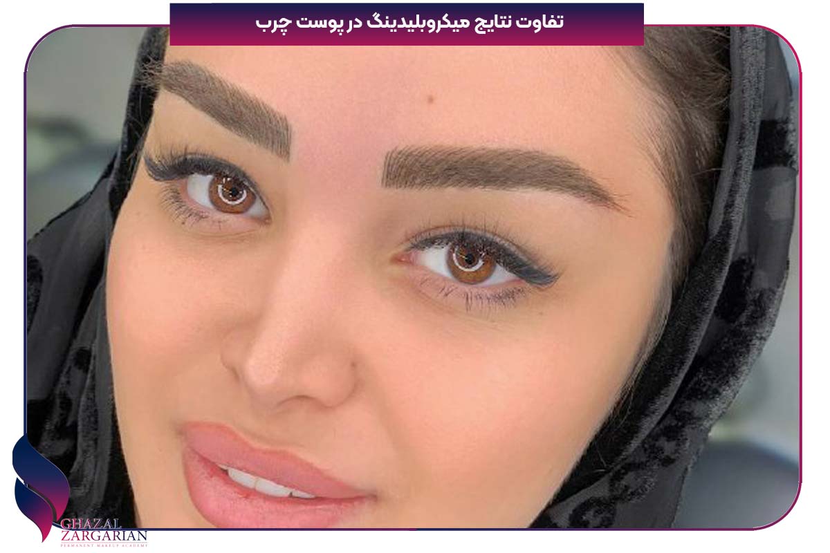 کم کردن چربی صورت