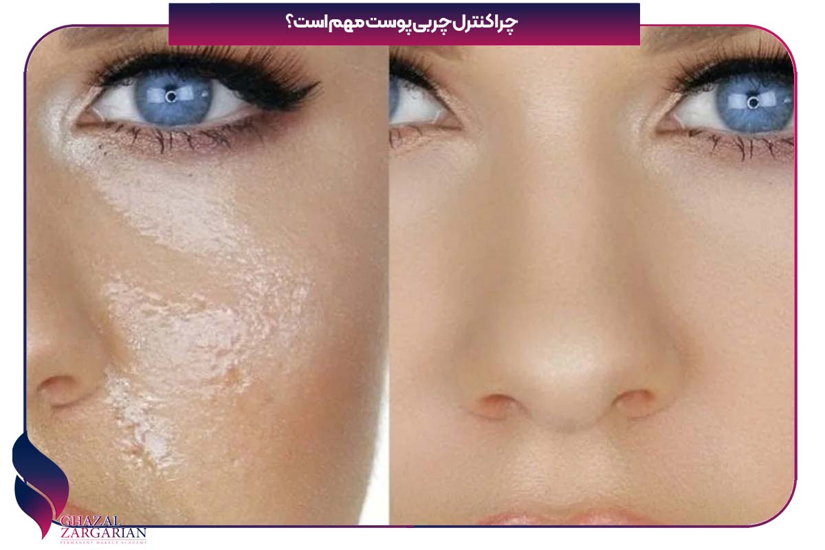 کنترل چربی پوست