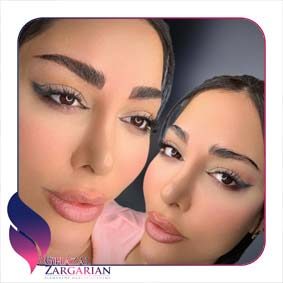 فیبروز ابرو طبیعی
