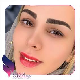 هزینه فیبروز ابرو