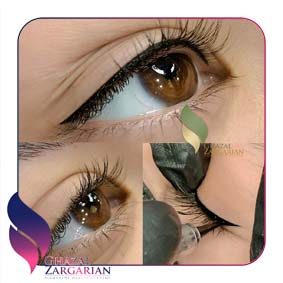 بن مژه بالا و پایین بن مژه بالا و پایین