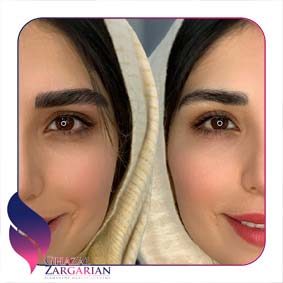 مدل های فیبروز ابرو