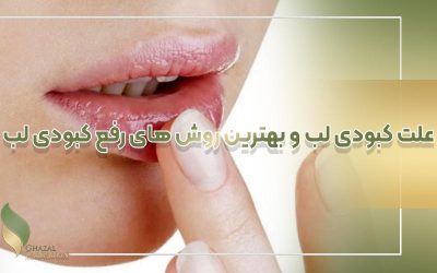 علت کبودی لب و بهترین روش های رفع کبودی لب